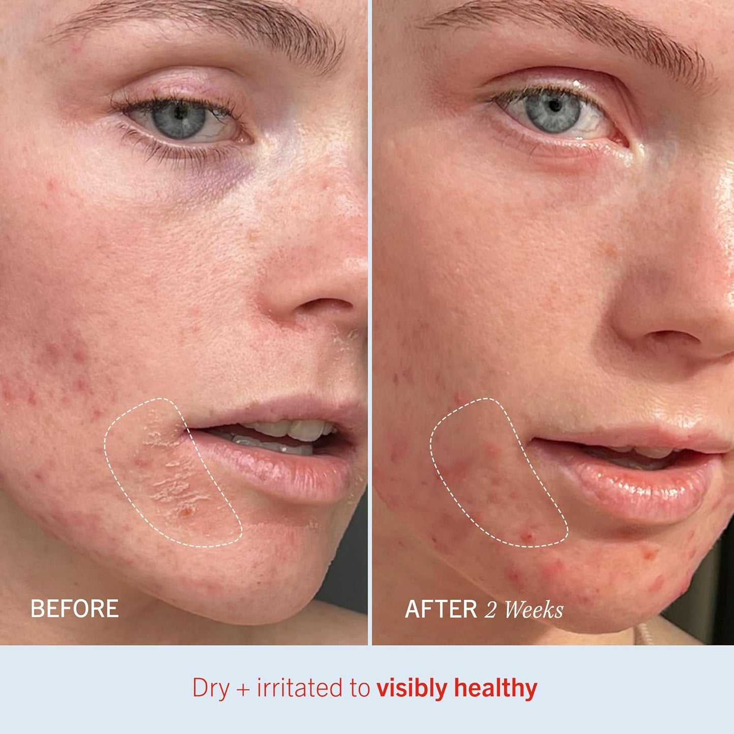 First Aid Beauty - Ultra Repair Cream, Intense Hydration Whipped Colloidal Oatmeal, Strengthens Skin Barrier in 7 Days & Helps Relieve Eczema, Luxury Face & Body Moisturizer, Grapefruit Scent, 12 oz