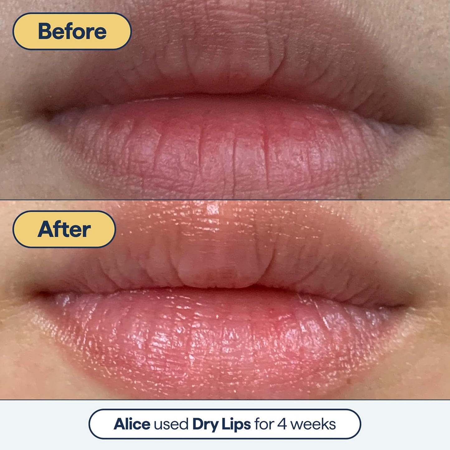 Remedy for Dry Lips - Hydrating and Healing Lip Balm Ointment with Ceramides, Peptides, and Dimethicone - Repairs Dry, Cracked Lips - By Dermatologist Dr. Shah